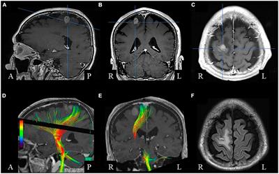 Impairment of bimanual in-phase movement during recovery from frontal lobe tumor surgery: a case report